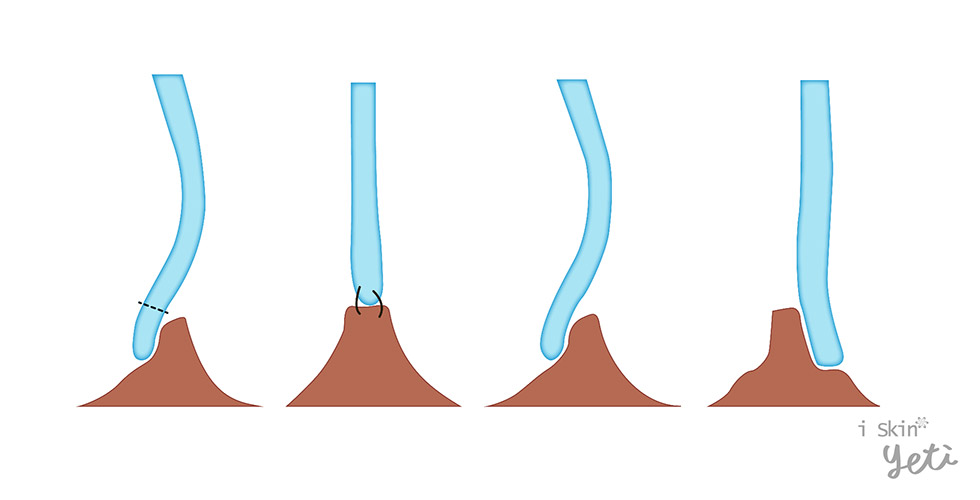 鼻中隔旋轉繞道術