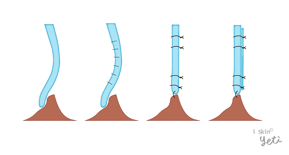 軟骨切痕縫合術